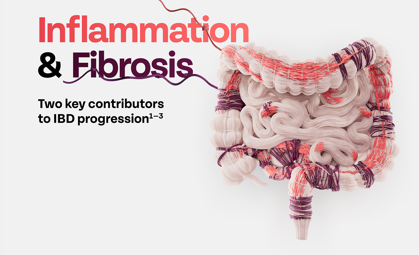 Woven Intestine With Coral “Inflammation”
and Purple “Fibrosis” Threads, “Two Key
Contributors to IBD Progression, Ref 1–3."
